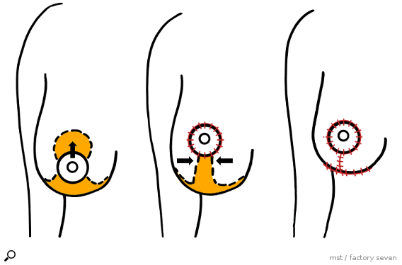 Brustverkleinerung - T-Methode (auch Technik nach Strömbeck oder Ankerschnitt genannt) 